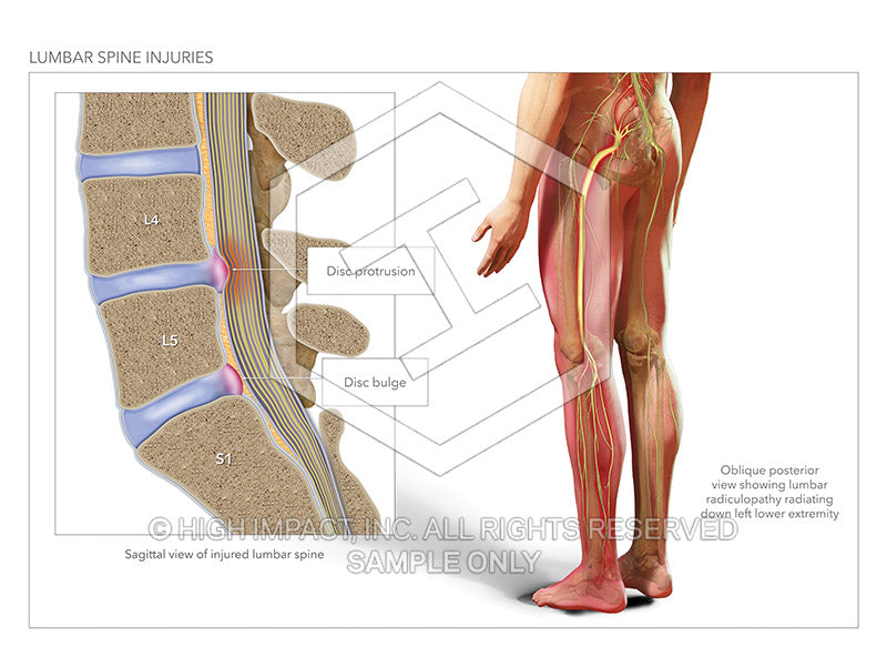 Image 18622: Lumbar Spine Injury with Disc Protrusion and Disc Bulge with Radiculopathy Illustration - Trial Guides