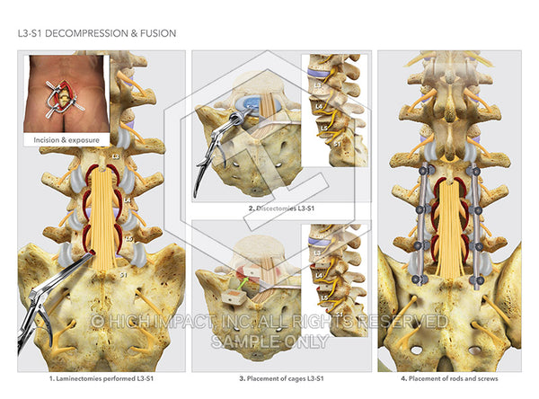 Image 18761: L3-S1 Decompression & Fusion Surgery Illustration - Trial Guides