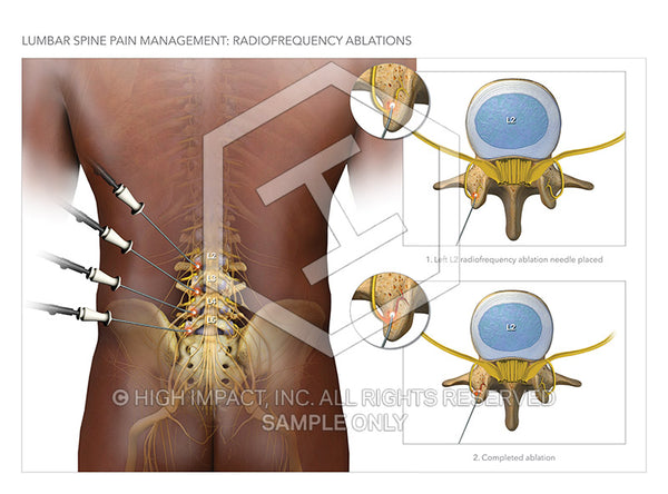 Image 18874: Lumbar Pain Management Injections Illustration - Trial Guides