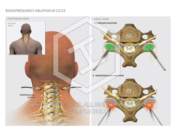 Image 18902: Cervical Spine Radiofrequency Ablation Illustration - Trial Guides