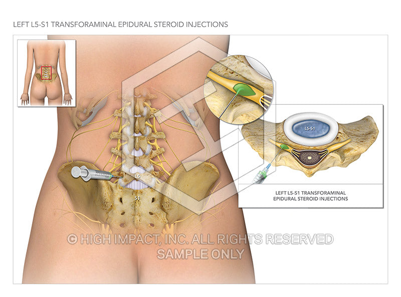 Image 19432: Transforaminal Epidural Injections Illustration - Trial Guides