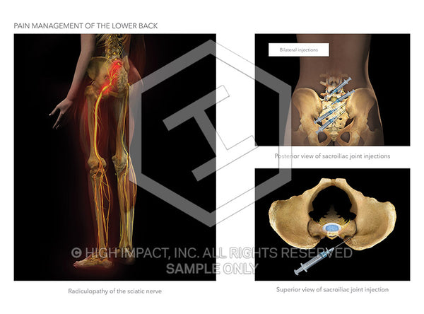 Image 19886: Sacroiliac Joint Injections Illustration - Trial Guides