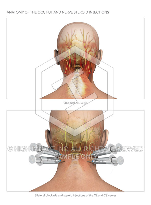 Image 19939: Occipital and Cervical Steroid Injections for Occipital Neuralgia Illustration - Trial Guides