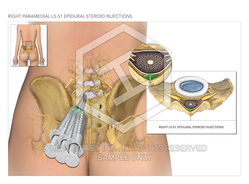 Image 20633: Lumbosacral Epidural Steroid Injections Illustration - Trial Guides