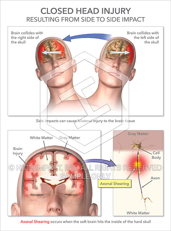 Image 20897: Closed Head Injury Illustration - Trial Guides